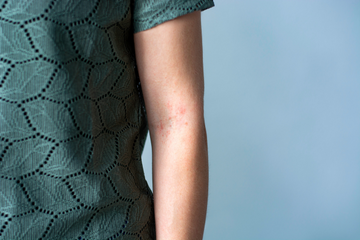 Spongy Moth Hairs irritation
