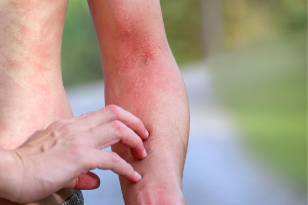 Fire Ant Bites: Treatment And Relief From The Itch